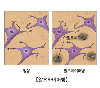 정상인과 알츠하이머병 뉴런 비교