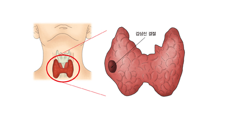 갑상선결절