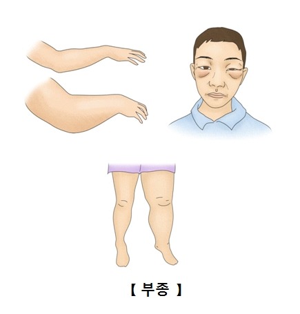 신증후군 부종