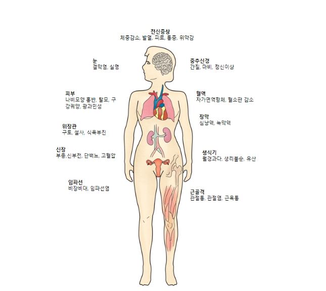 전신성 홍반성 낭창(SLE)